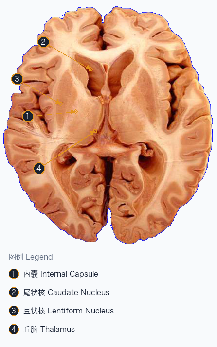 内囊轴位空间定位 Internal Capsule Axial Locator — Annotated / 标注图
