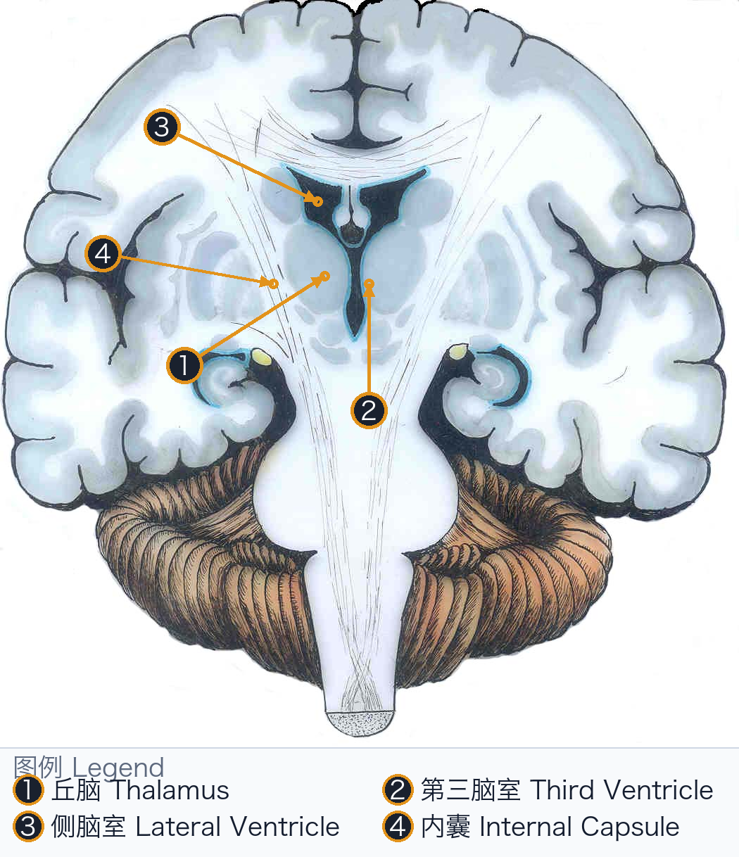丘脑—第三脑室—内囊 Thalamus–Third Ventricle–Internal Capsule — Annotated / 标注图